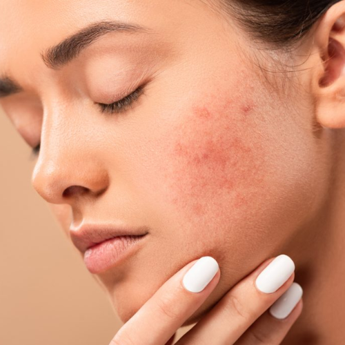 Acne Treatment in thane