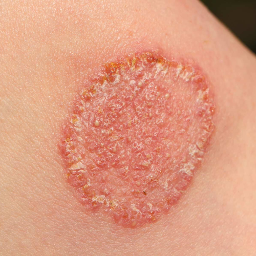 Best Viral Skin Infection Treatment in Vasant Vihar